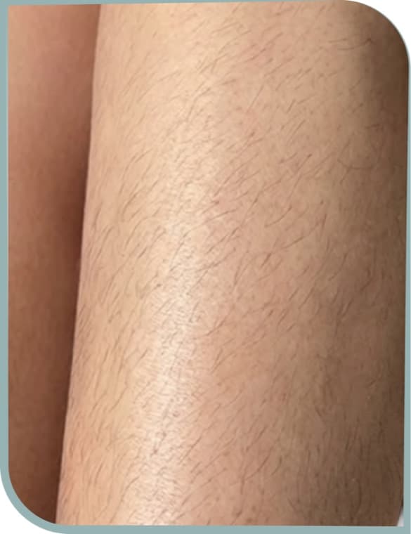 Leg hair reduction, Before photo (result 3 of 10)