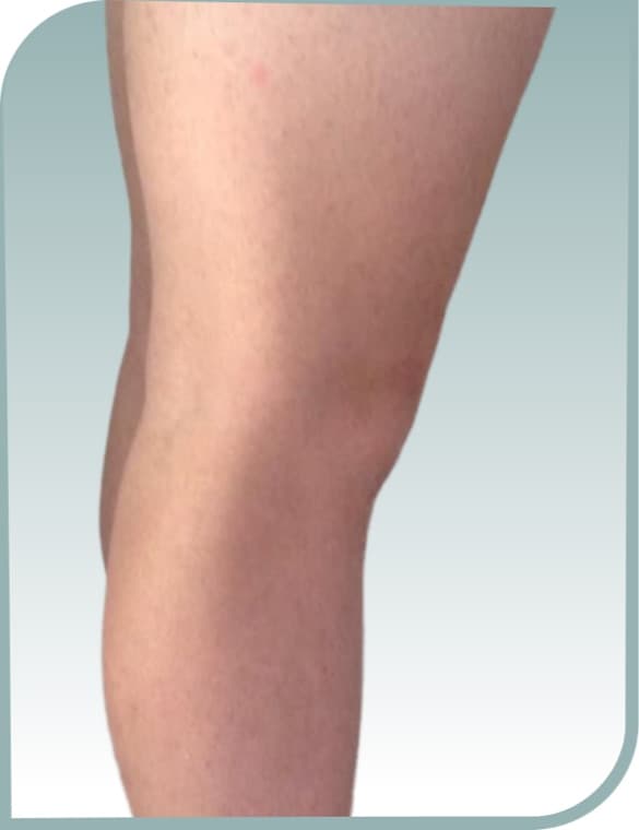 Lower leg hair, After photo (result 1 of 10)