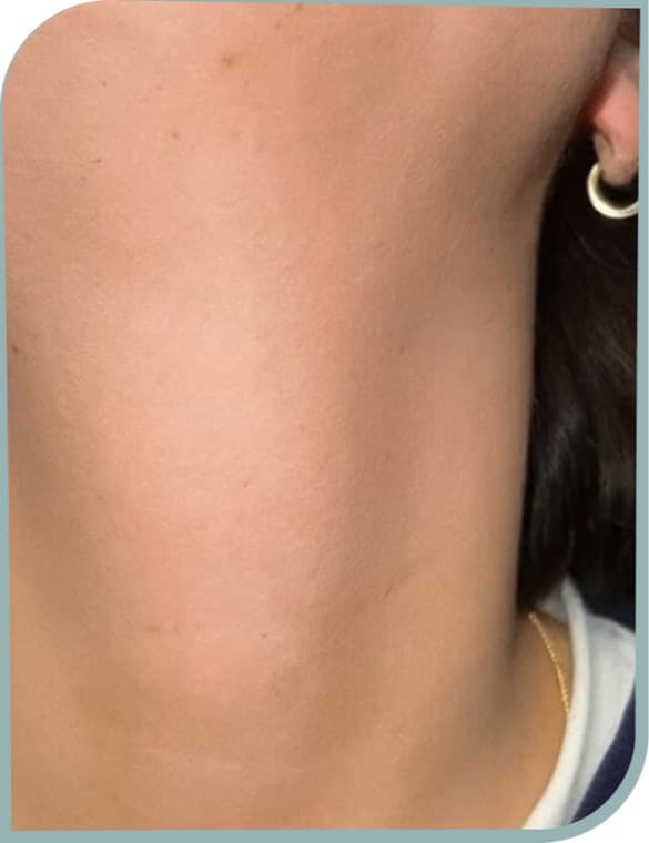Neck hair reduction, After photo (result 7 of 10)
