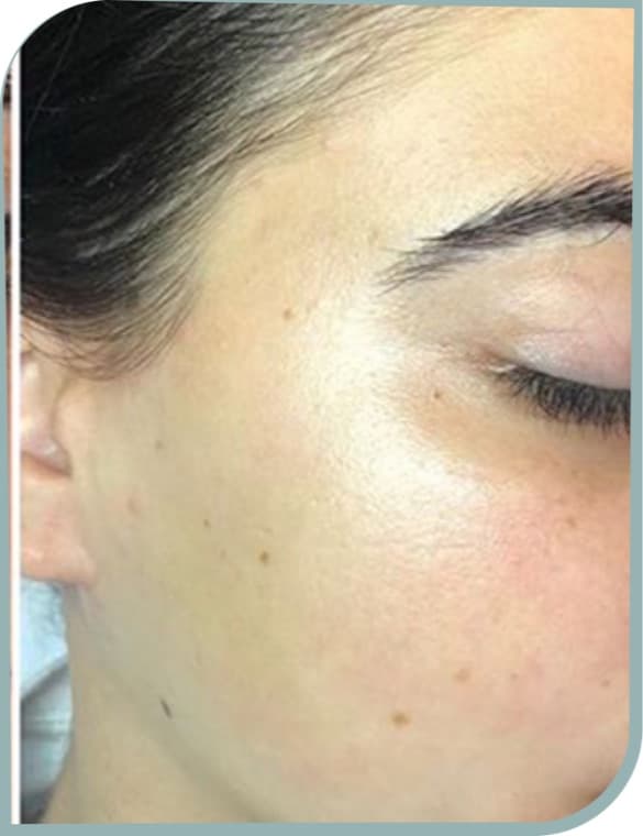 Facial cheek hair, After photo (result 5 of 10)