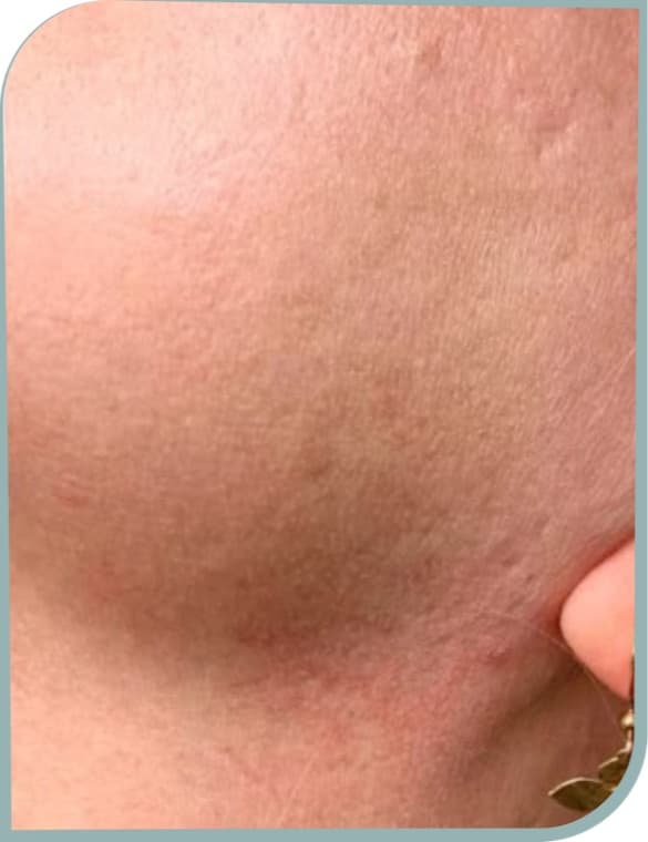 Jawline hair, After photo (result 6 of 10)
