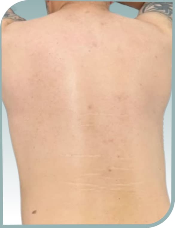 Back hair removal, After photo (result 4 of 10)