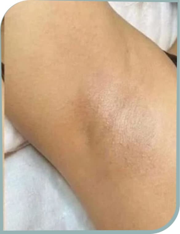 Underarm hair, After photo (result 9 of 10)