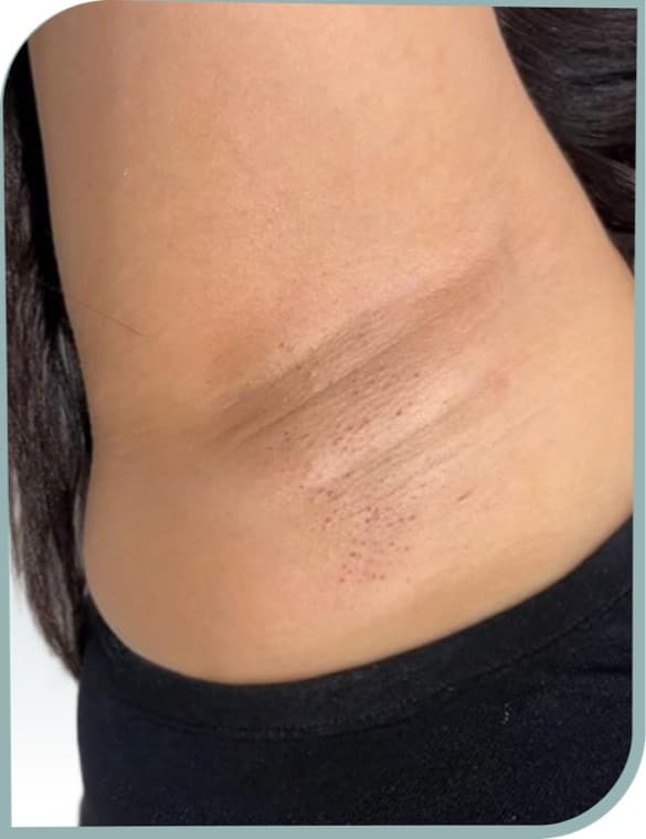 Underarm hair, After photo (result 10 of 10)