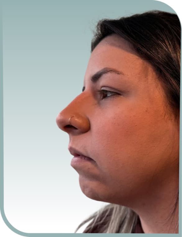 Subtle lip definition, Before photo (result 1 of 10)