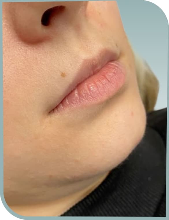 Added lip volume, Before photo (result 2 of 10)