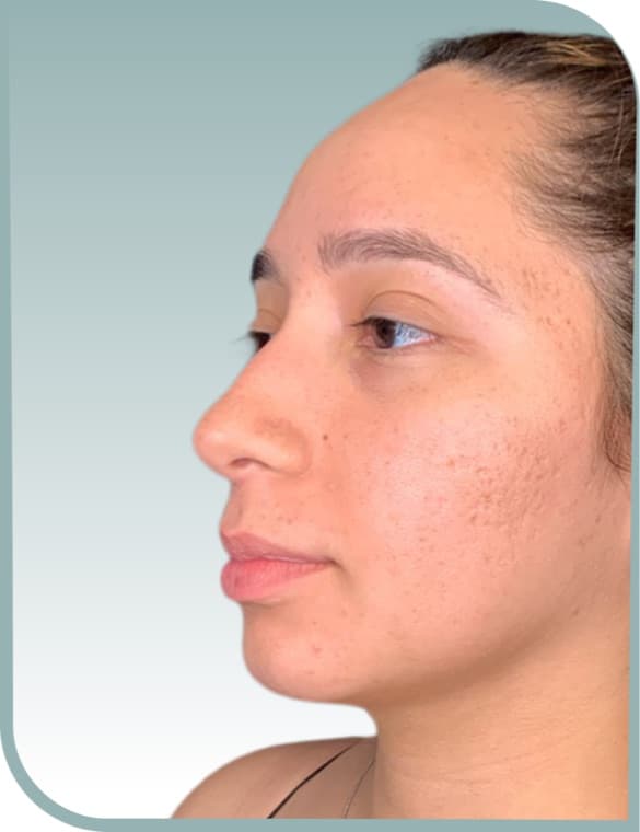 Gentle lip enhancement, Before photo (result 3 of 10)