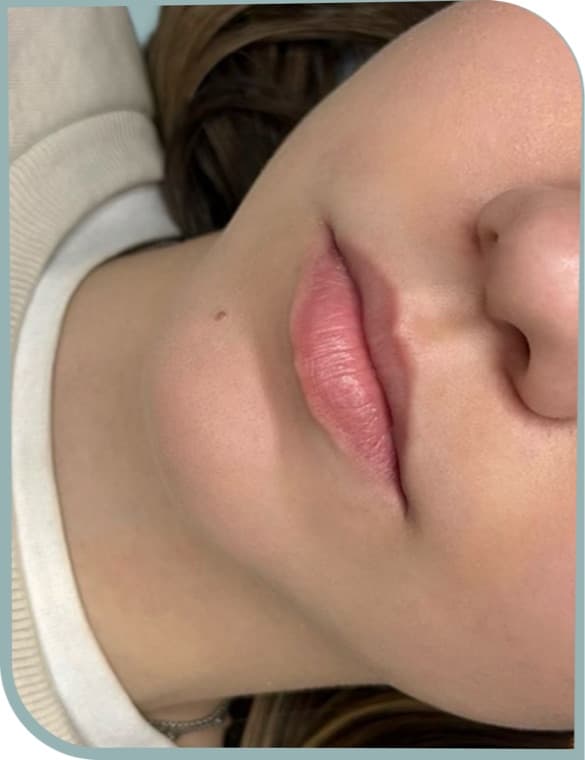 Lip shaping, Before photo (result 4 of 10)