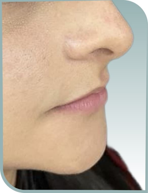 Fuller lip profile, Before photo (result 7 of 10)