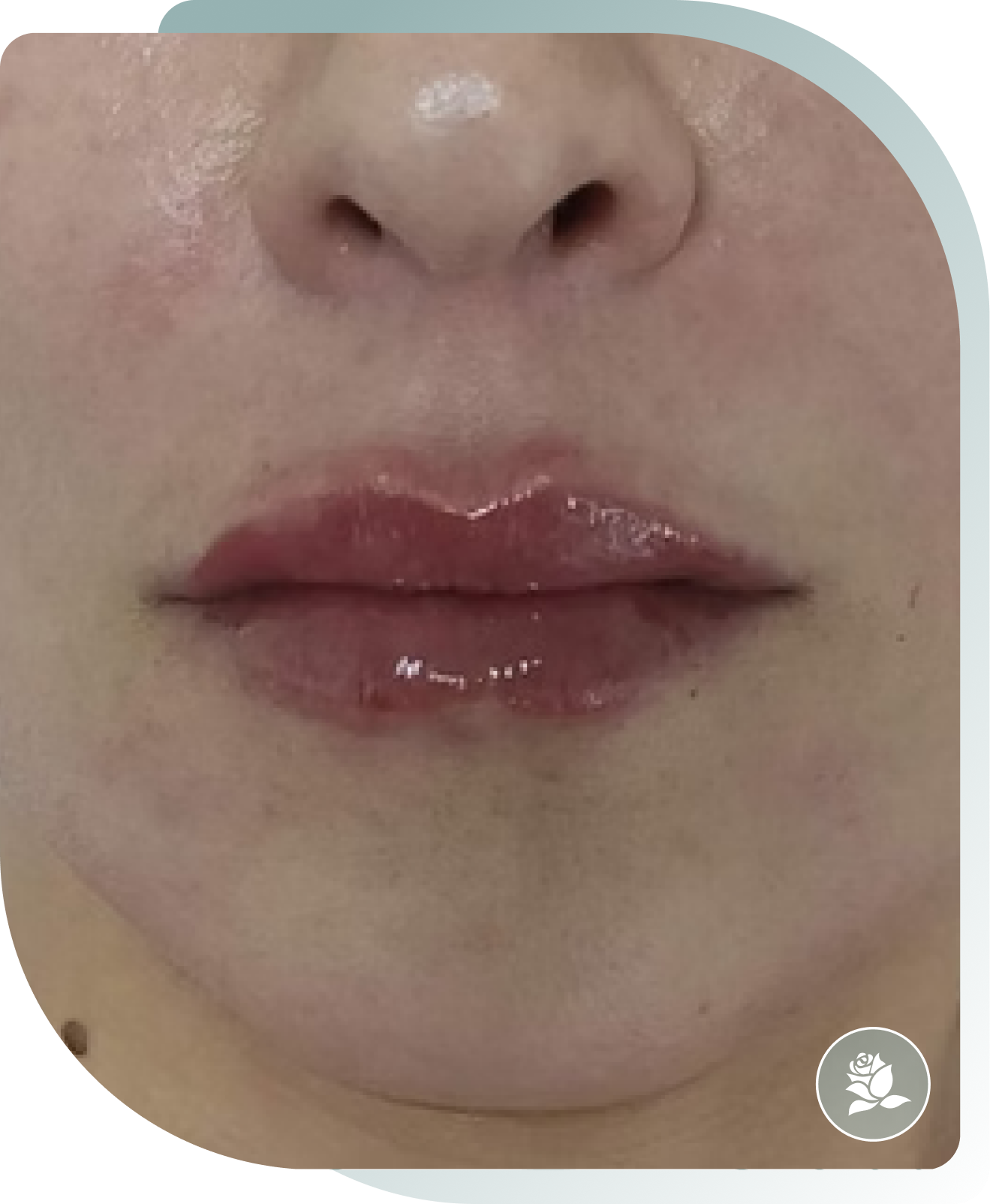 Contour & Cupid's Bow — After photo (result 4 of 5)