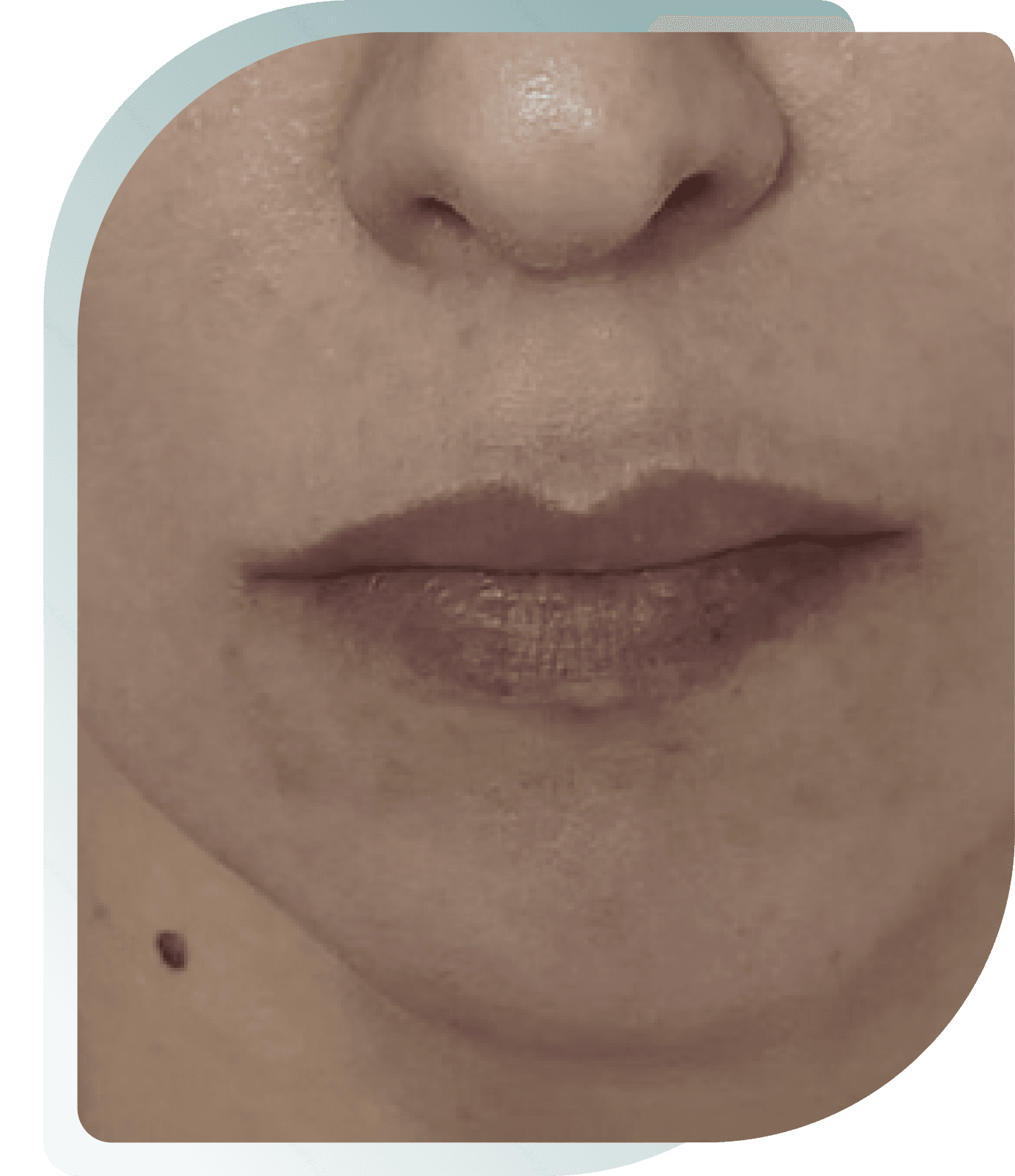 Contour & Cupid's Bow — Before photo (result 4 of 5)