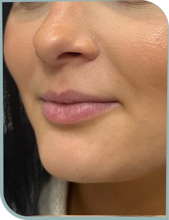 Lip augmentation, Before photo (result 9 of 10)