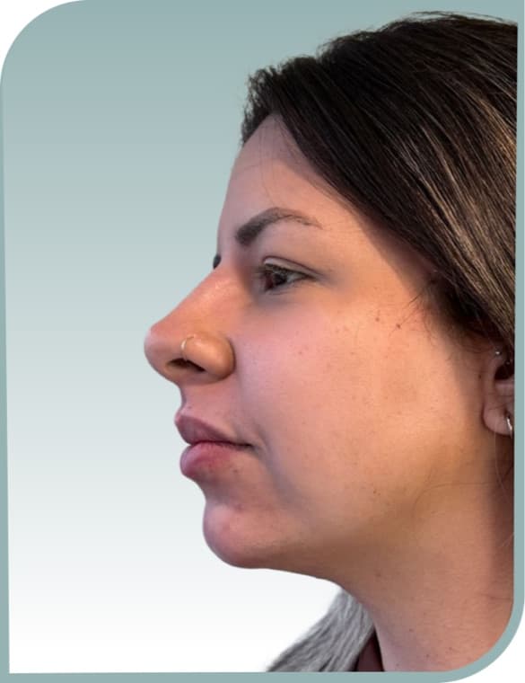 Subtle lip definition, After photo (result 1 of 10)