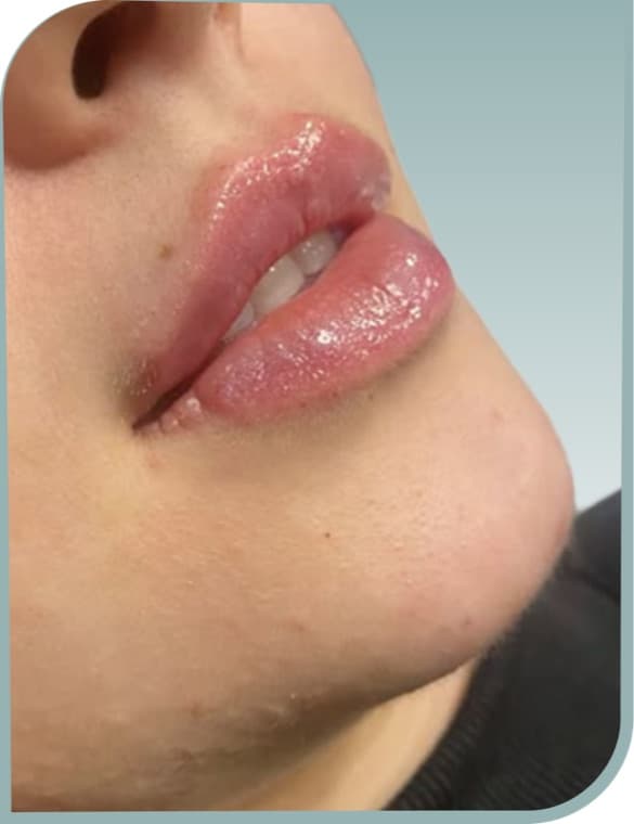 Added lip volume, After photo (result 2 of 10)