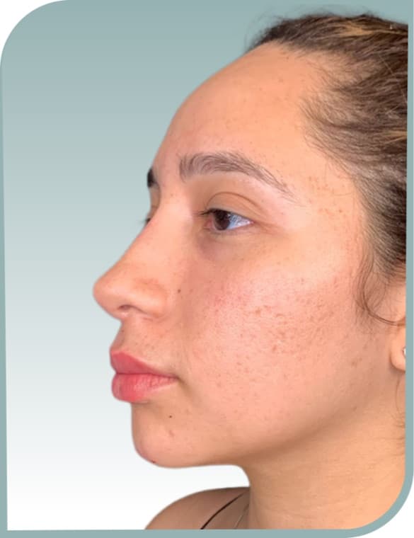 Gentle lip enhancement, After photo (result 3 of 10)