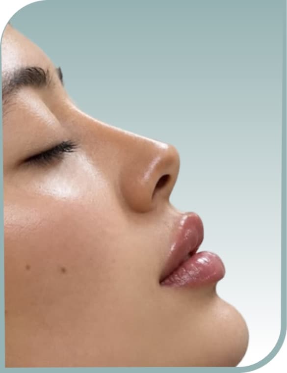 Balanced lip volume, After photo (result 5 of 10)