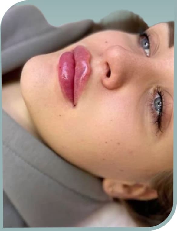 Defined lip border, After photo (result 6 of 10)