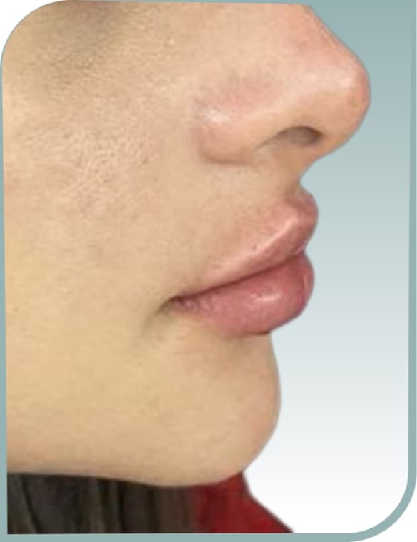 Fuller lip profile, After photo (result 7 of 10)