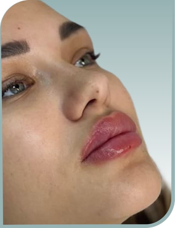 Even lip volume, After photo (result 8 of 10)