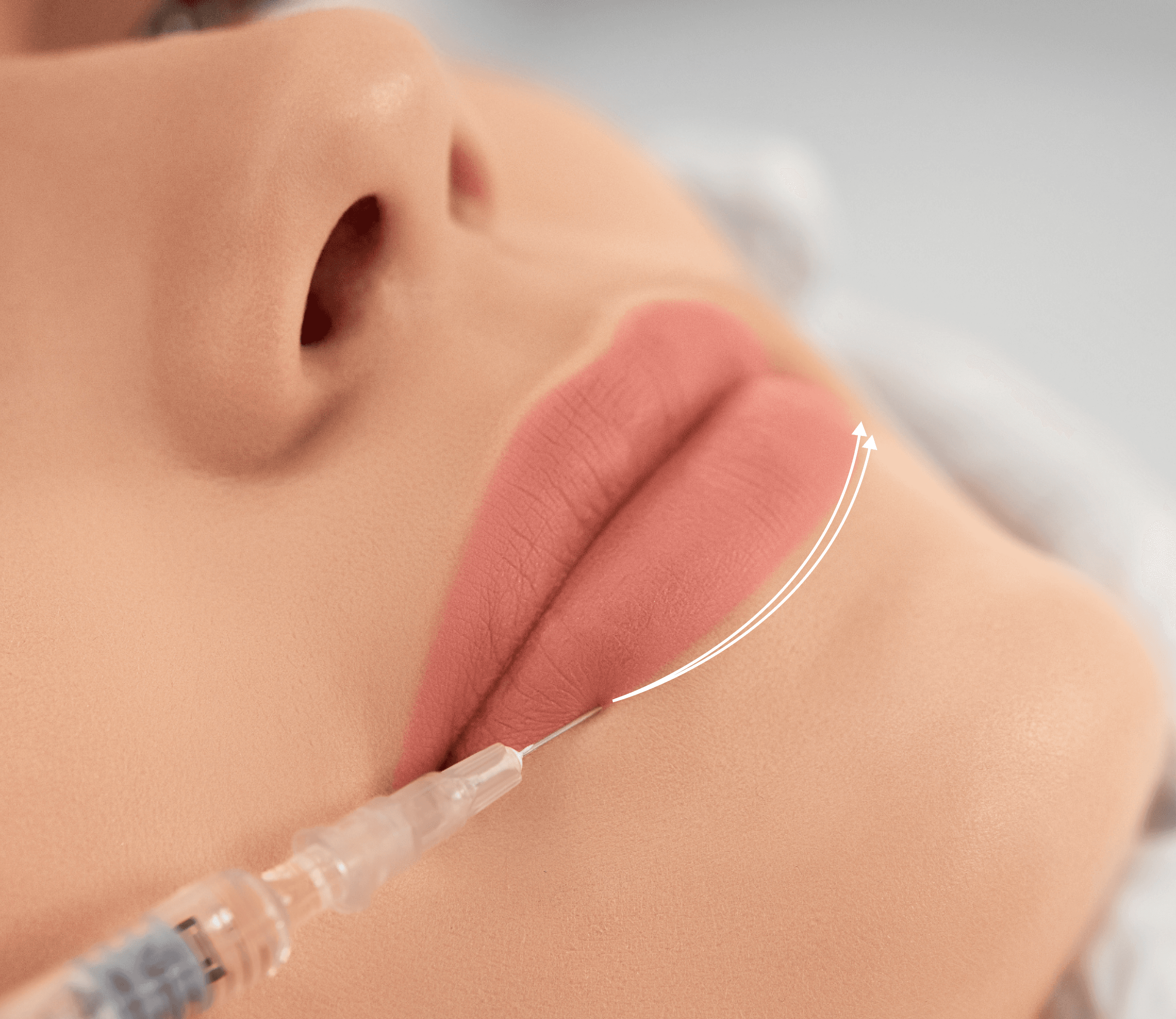 Lip fillers treatment at Carisma Aesthetics Malta