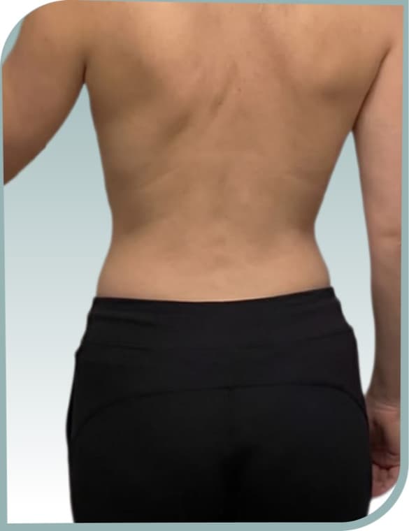 Back and bra-line slimming, After photo (result 10 of 10)