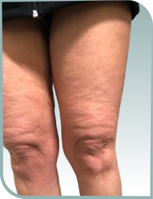 Thigh and knee texture, Before photo (result 4 of 10)