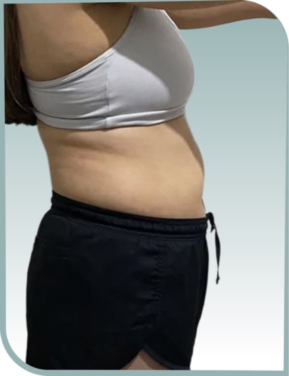 Lower tummy slimming, Before photo (result 8 of 10)