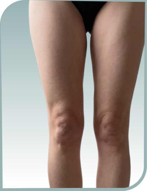 Front thigh smoothing, After photo (result 5 of 10)