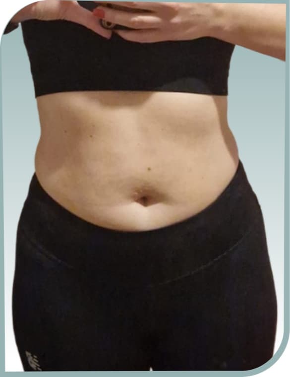 Tummy slimming, After photo (result 7 of 10)