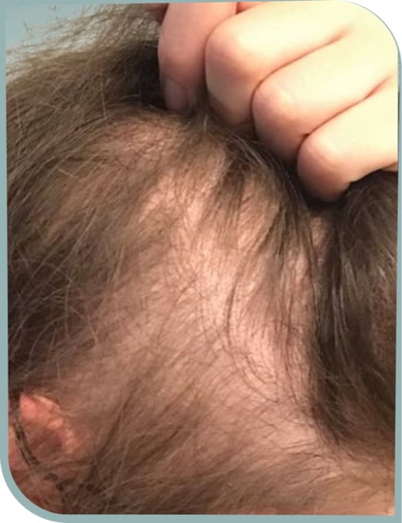 Thinning crown, Before photo (result 1 of 10)