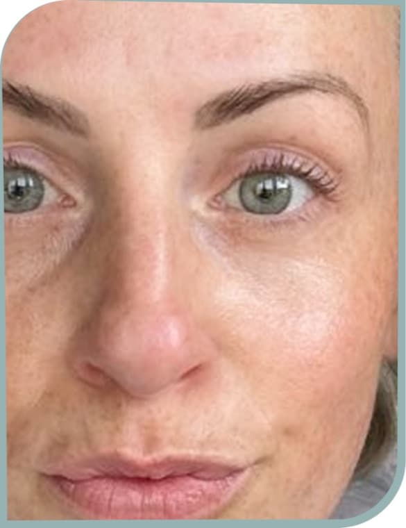 Pigment around nose, After photo (result 10 of 10)