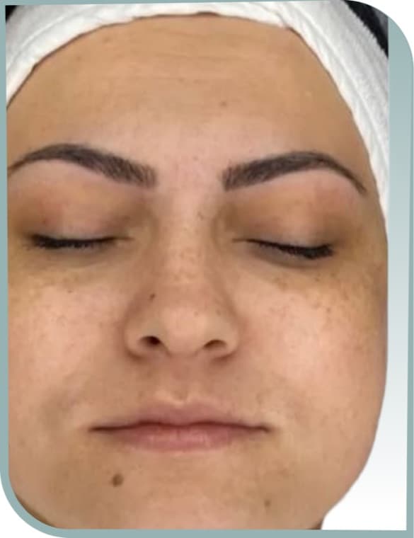 Dull dehydrated skin, Before photo (result 2 of 10)