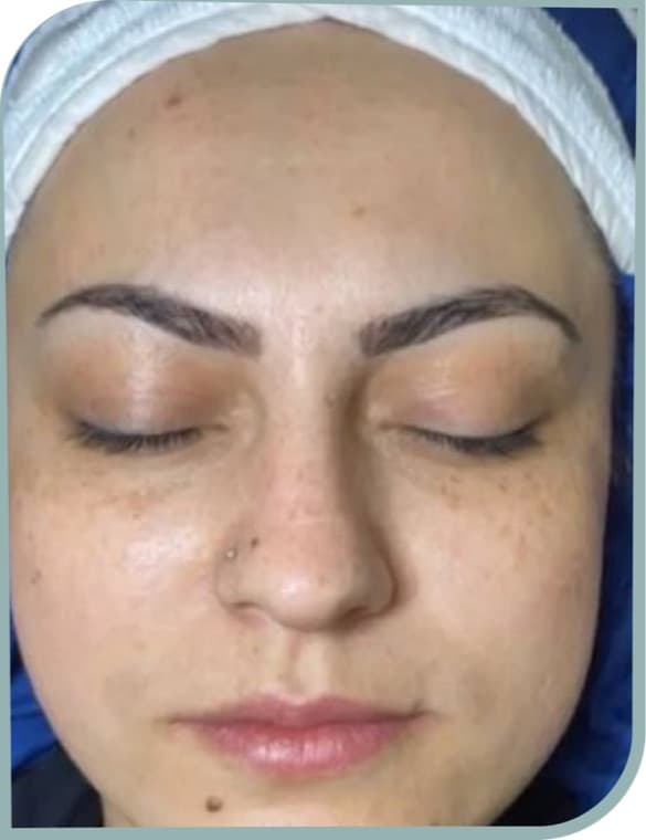 Dull dehydrated skin, After photo (result 2 of 10)