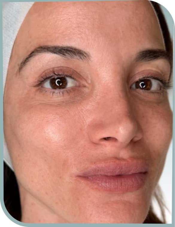Cheek sun spots, Before photo (result 3 of 10)
