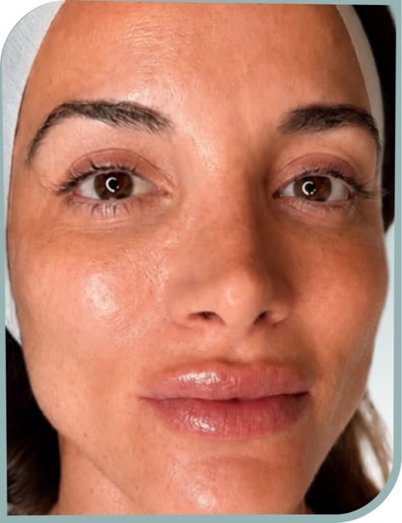 Cheek sun spots, After photo (result 3 of 10)