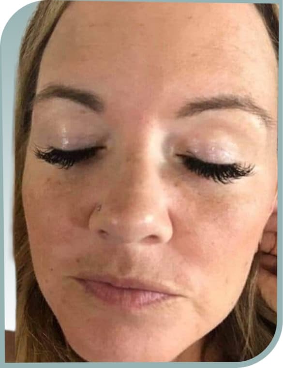 Melasma patches, After photo (result 4 of 10)