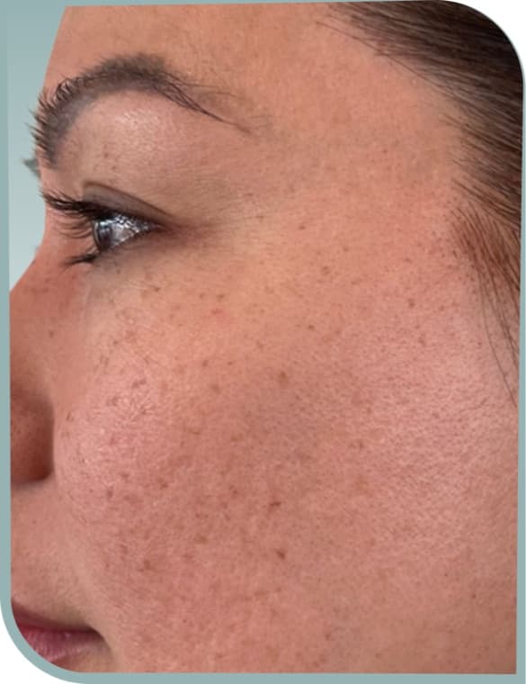 Freckled cheeks, Before photo (result 5 of 10)
