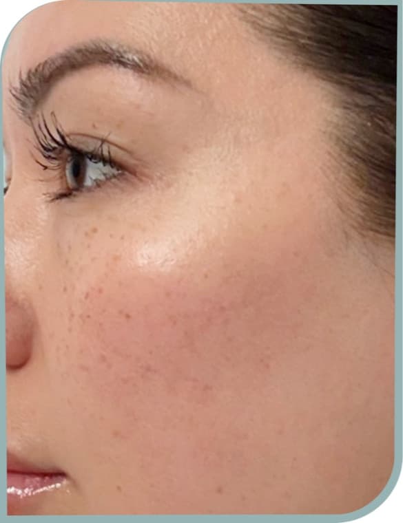 Freckled cheeks, After photo (result 5 of 10)