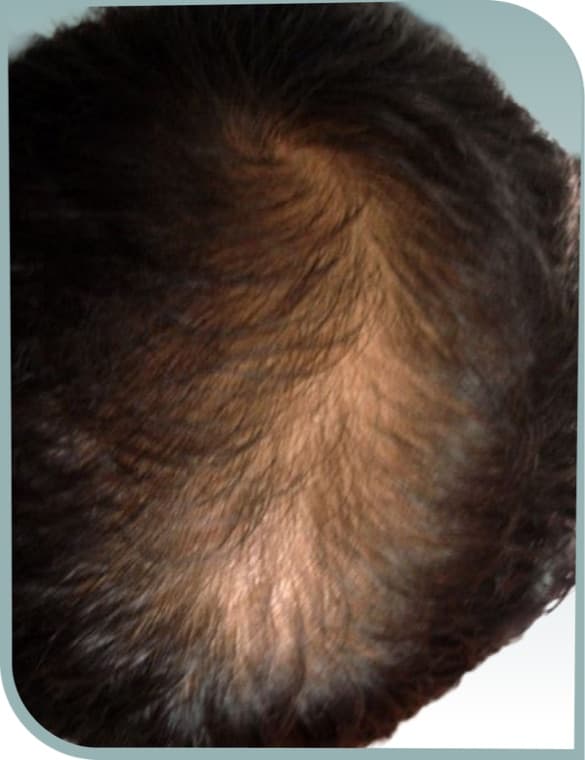 Crown hair loss, Before photo (result 6 of 10)