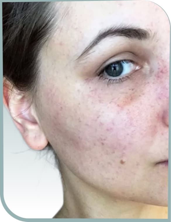 Cheek redness, Before photo (result 7 of 10)