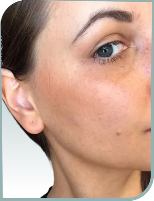 Cheek redness, After photo (result 7 of 10)