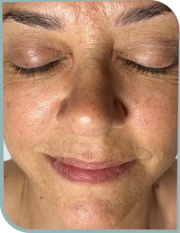 Fine lines, Before photo (result 8 of 10)