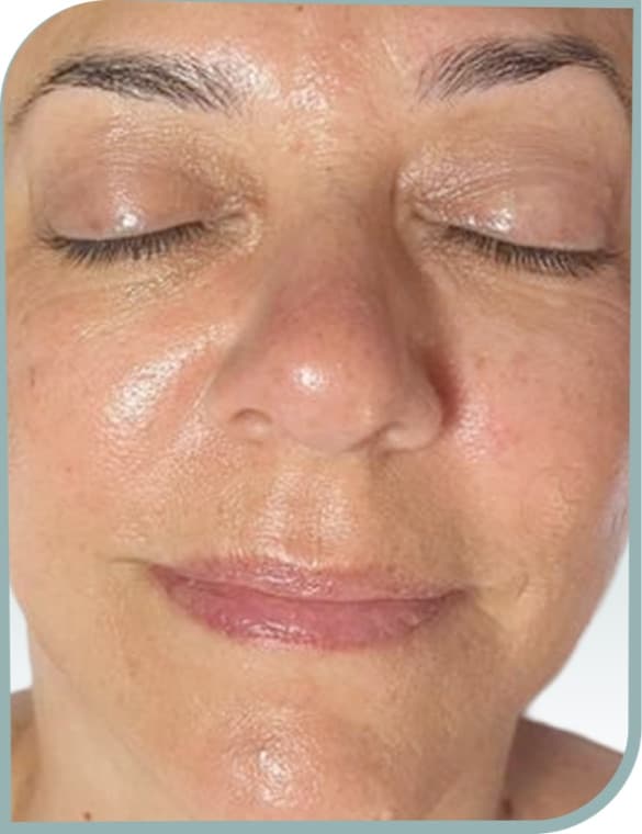 Fine lines, After photo (result 8 of 10)