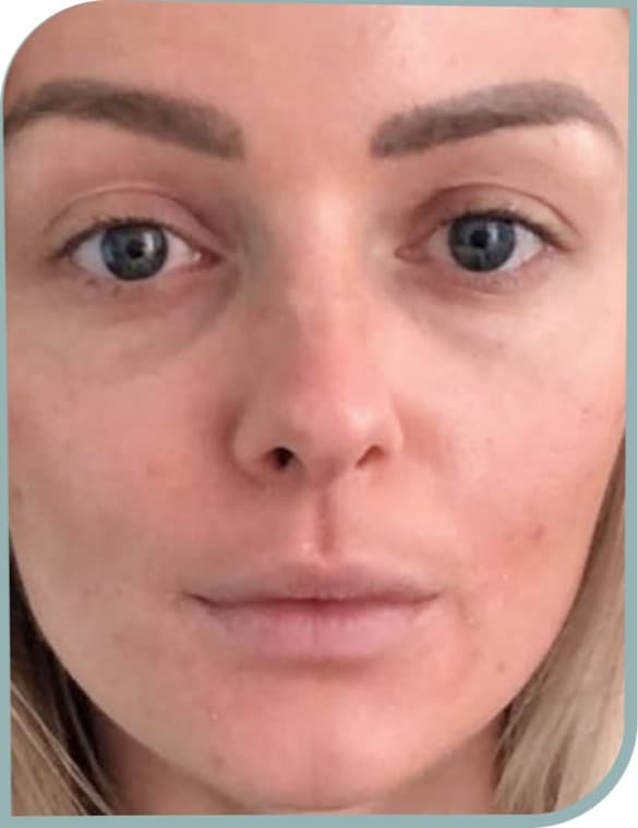 Under-eye shadows, After photo (result 9 of 10)