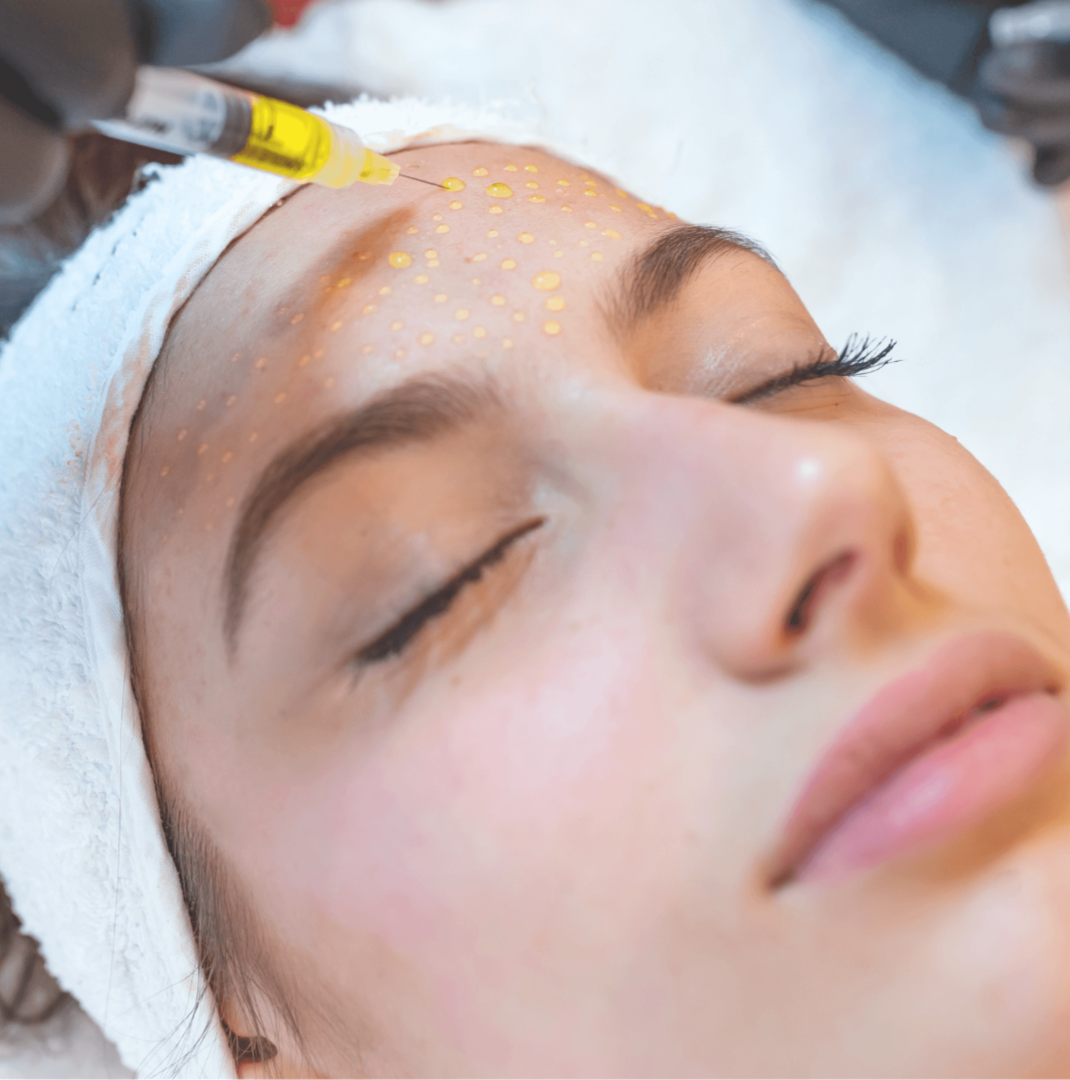 Mesotherapy treatment at Carisma Aesthetics Malta