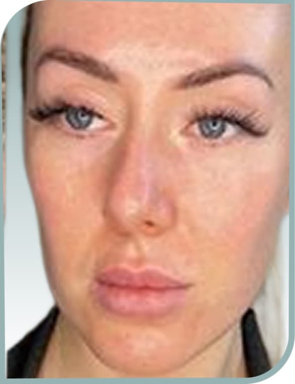 Redness and tone, After photo (result 1 of 10)