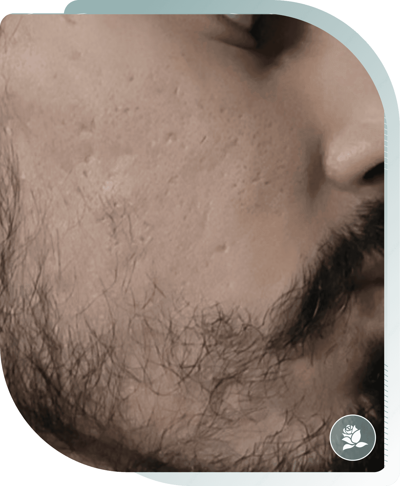 After photo: Microneedling result at Carisma Aesthetics Malta