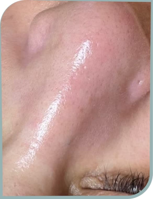 Pore refinement, After photo (result 10 of 10)