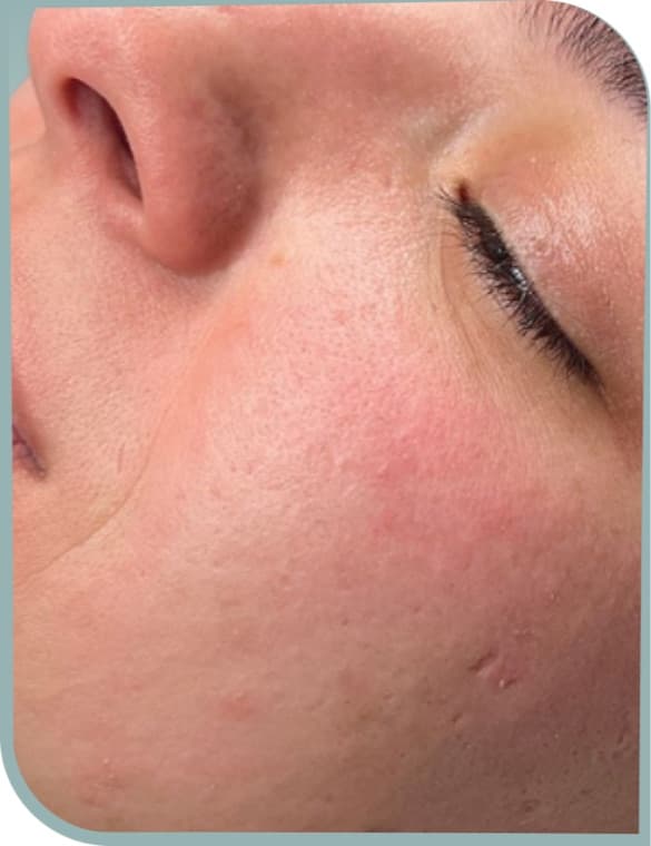 Cheek texture, After photo (result 2 of 10)
