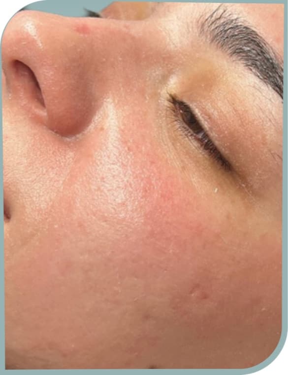 Cheek texture, Before photo (result 2 of 10)